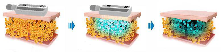 CryoPlate 8X Pro – APARAT Profesional Criolipoliză Flat fără Vacuum pentru Remodelare Corporală - imagine 6